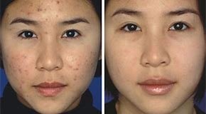 sesiones-luz-pulsada-intensa-acne.jpg luz pulsada eliminar acne